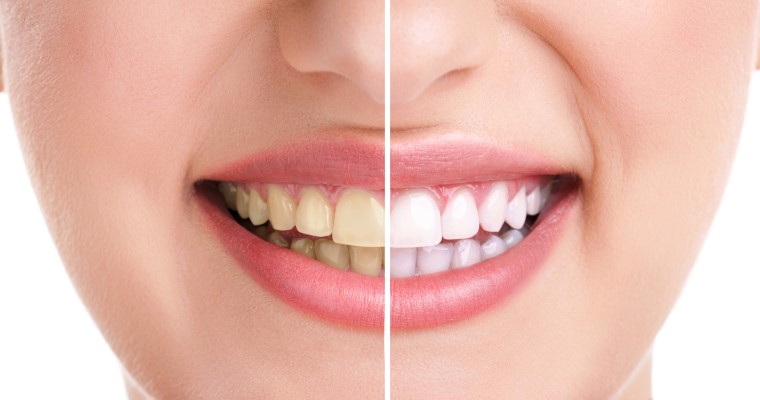 Woman's smile bisected with before teeth whitening on the left and after on the right